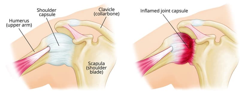 Physiotherapy for Frozen Shoulder