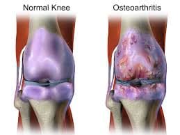 Physiotherapy for Arthritis